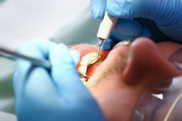 Best Emergency Treatment for Dental Infections or Abscesses in New Richmond, OH